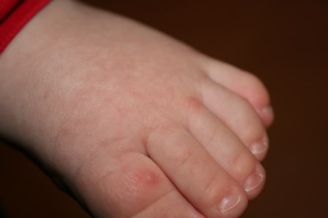 Pimples, puss filled ant bite looking bumps on toddlers ...